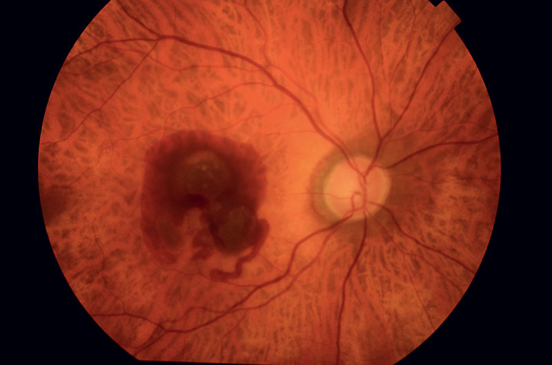 Rétinographie. La tache sombre est compatible avec une DMLA hémorragique néovasculaire. © Centre d’imagerie oculaire, Hôpital ophtalmique Jules-Gonin
